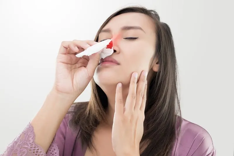 Epistaxis nasal